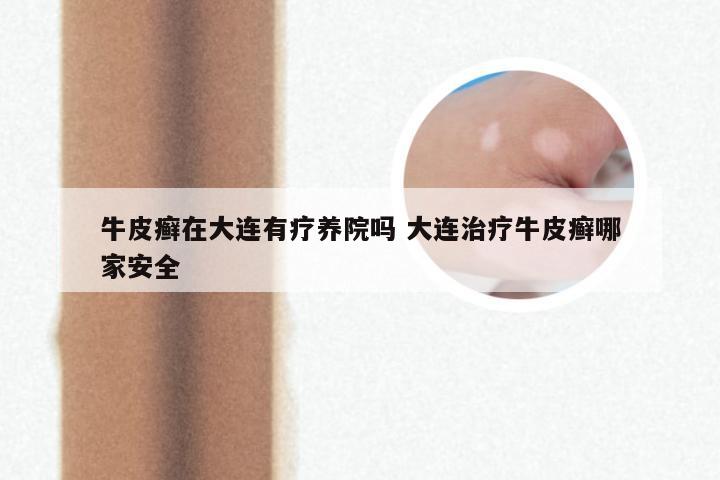 牛皮癣在大连有疗养院吗 大连治疗牛皮癣哪家安全