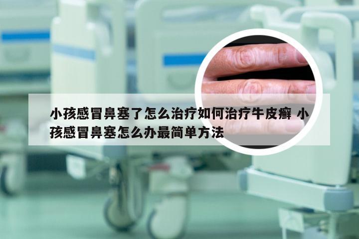 小孩感冒鼻塞了怎么治疗如何治疗牛皮癣 小孩感冒鼻塞怎么办最简单方法