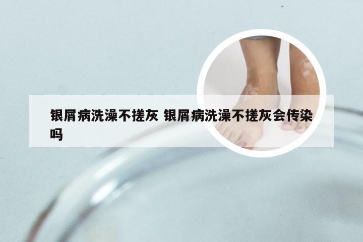 银屑病洗澡不搓灰 银屑病洗澡不搓灰会传染吗