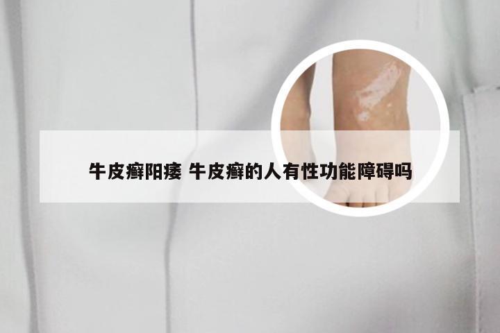 牛皮癣阳痿 牛皮癣的人有性功能障碍吗