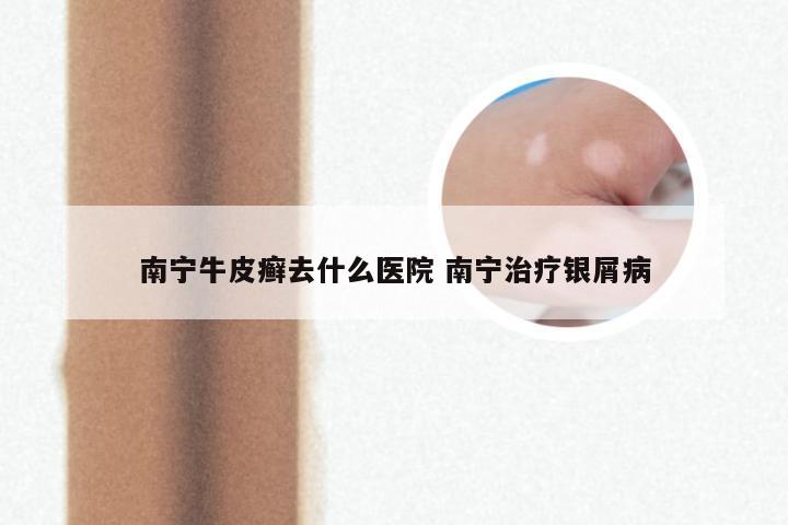 南宁牛皮癣去什么医院 南宁治疗银屑病
