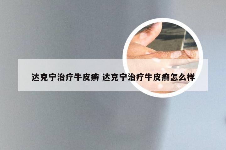 达克宁治疗牛皮癣 达克宁治疗牛皮癣怎么样