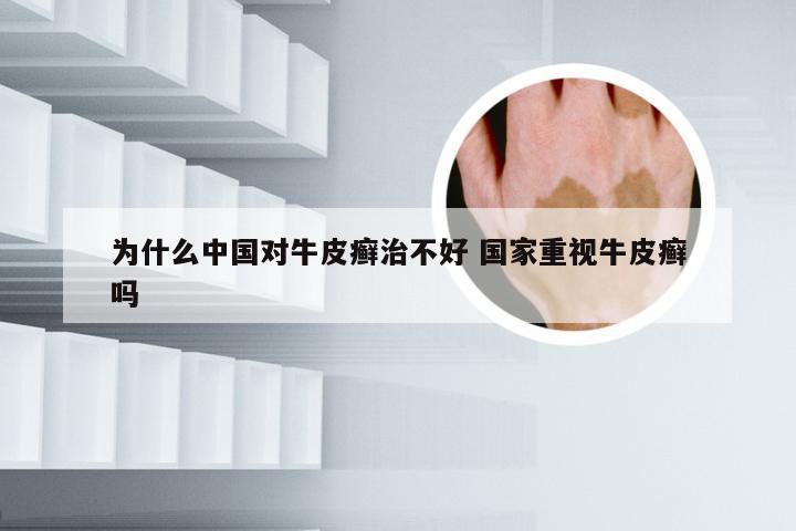 为什么中国对牛皮癣治不好 国家重视牛皮癣吗