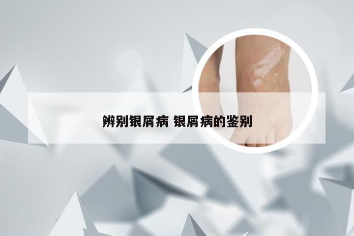 辨别银屑病 银屑病的鉴别