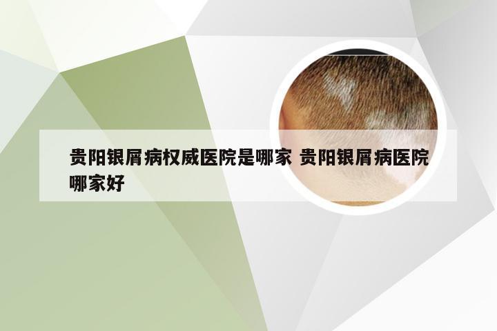 贵阳银屑病权威医院是哪家 贵阳银屑病医院哪家好