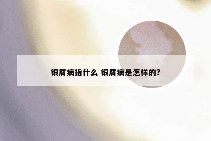 银屑病指什么 银屑病是怎样的?