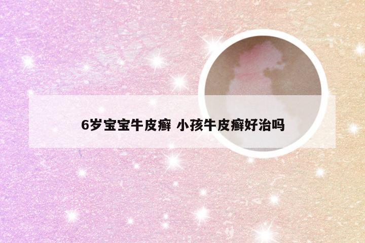 6岁宝宝牛皮癣 小孩牛皮癣好治吗