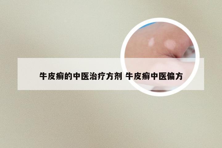 牛皮癣的中医治疗方剂 牛皮癣中医偏方