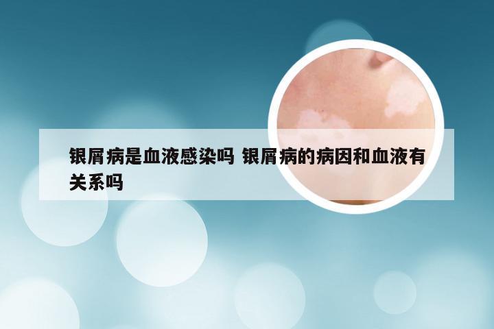 银屑病是血液感染吗 银屑病的病因和血液有关系吗