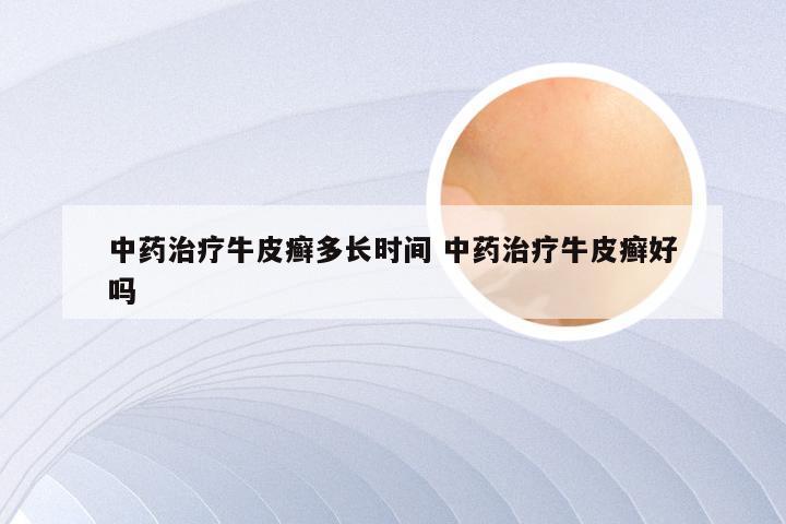 中药治疗牛皮癣多长时间 中药治疗牛皮癣好吗