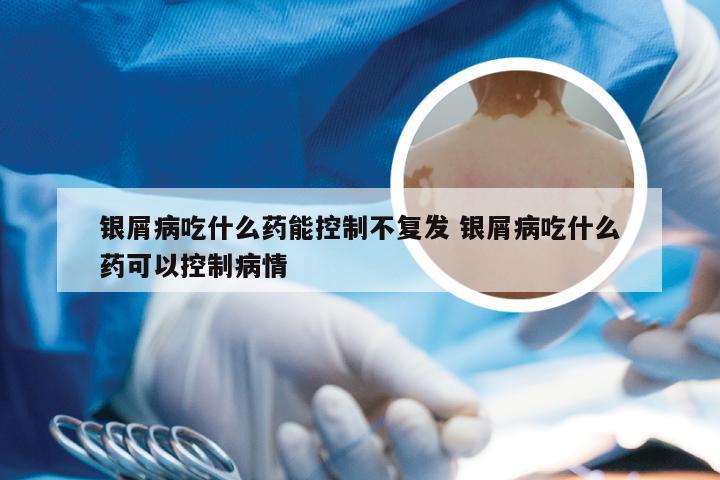 银屑病吃什么药能控制不复发 银屑病吃什么药可以控制病情