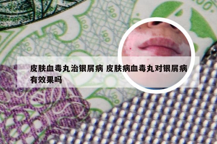 皮肤血毒丸治银屑病 皮肤病血毒丸对银屑病有效果吗
