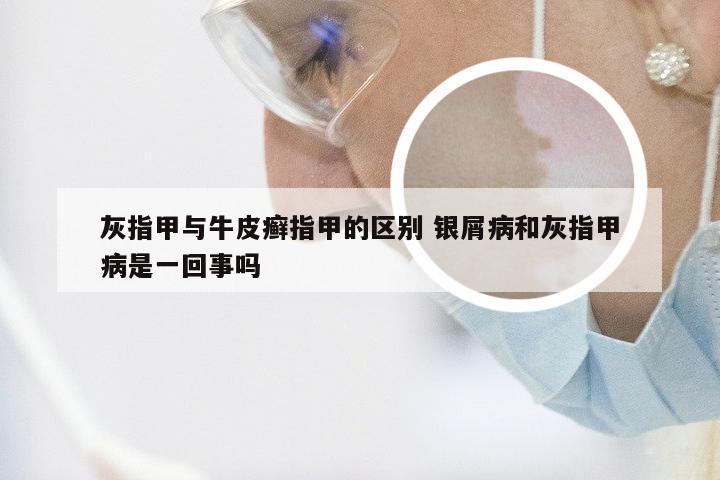 灰指甲与牛皮癣指甲的区别 银屑病和灰指甲病是一回事吗