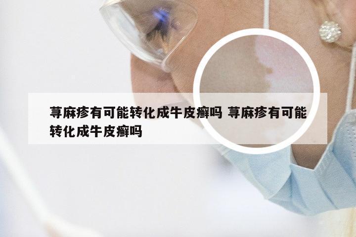 荨麻疹有可能转化成牛皮癣吗 荨麻疹有可能转化成牛皮癣吗