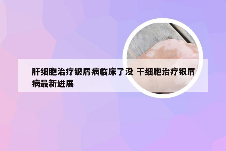 肝细胞治疗银屑病临床了没 干细胞治疗银屑病最新进展