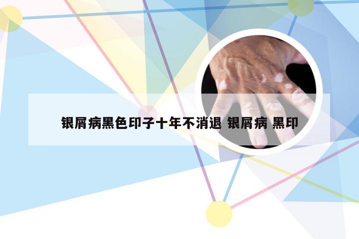 银屑病黑色印子十年不消退 银屑病 黑印