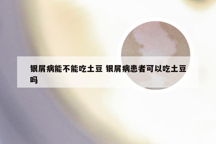 银屑病能不能吃土豆 银屑病患者可以吃土豆吗