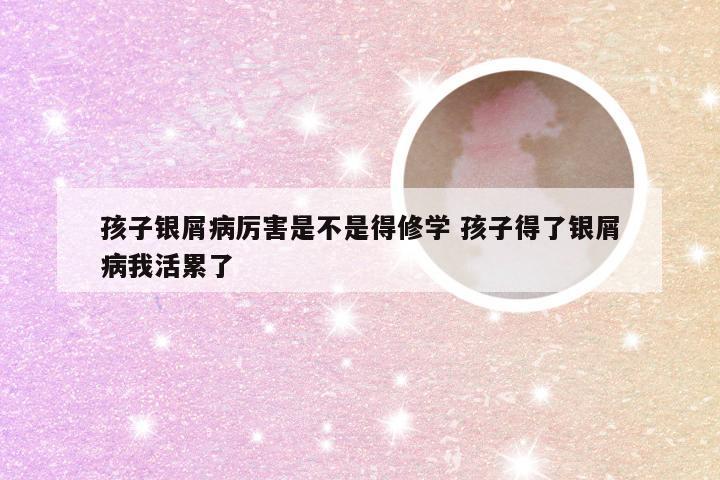 孩子银屑病厉害是不是得修学 孩子得了银屑病我活累了