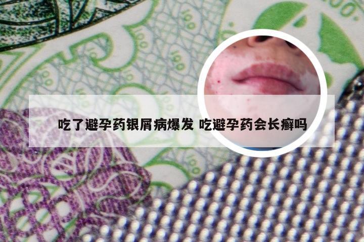 吃了避孕药银屑病爆发 吃避孕药会长癣吗