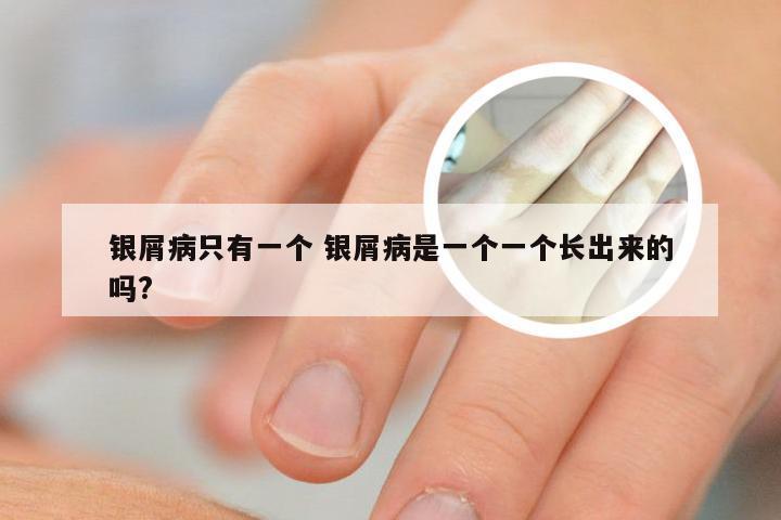 银屑病只有一个 银屑病是一个一个长出来的吗?