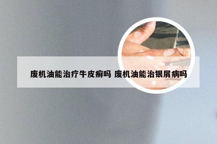 废机油能治疗牛皮癣吗 废机油能治银屑病吗