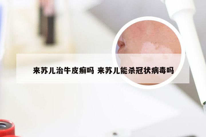 来苏儿治牛皮癣吗 来苏儿能杀冠状病毒吗