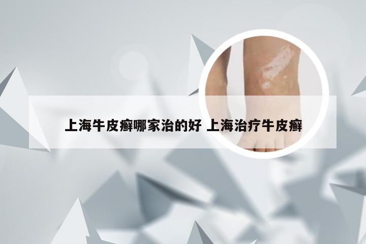 上海牛皮癣哪家治的好 上海治疗牛皮癣