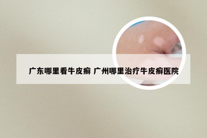 广东哪里看牛皮癣 广州哪里治疗牛皮癣医院