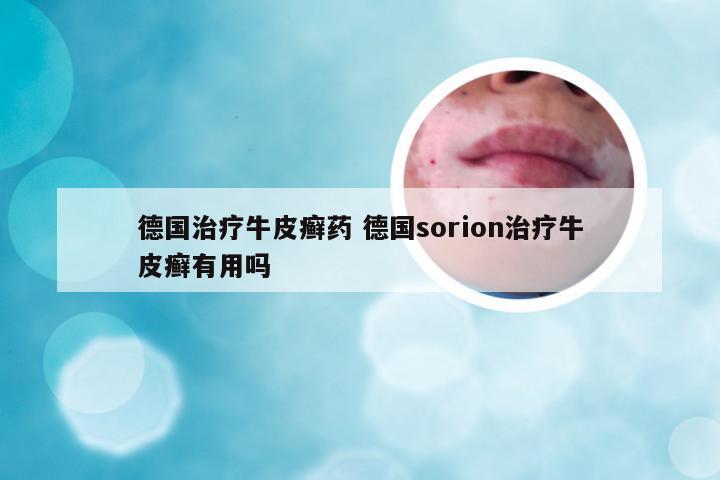 德国治疗牛皮癣药 德国sorion治疗牛皮癣有用吗