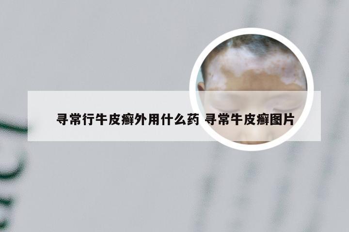寻常行牛皮癣外用什么药 寻常牛皮癣图片