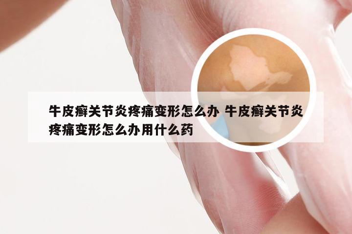 牛皮癣关节炎疼痛变形怎么办 牛皮癣关节炎疼痛变形怎么办用什么药