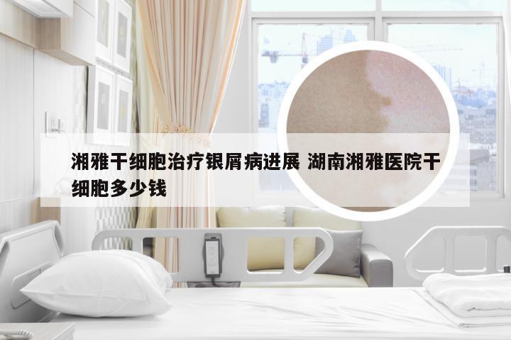 湘雅干细胞治疗银屑病进展 湖南湘雅医院干细胞多少钱