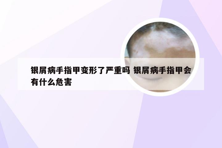 银屑病手指甲变形了严重吗 银屑病手指甲会有什么危害