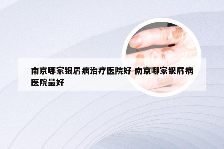 南京哪家银屑病治疗医院好 南京哪家银屑病医院最好