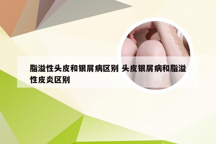 脂溢性头皮和银屑病区别 头皮银屑病和脂溢性皮炎区别