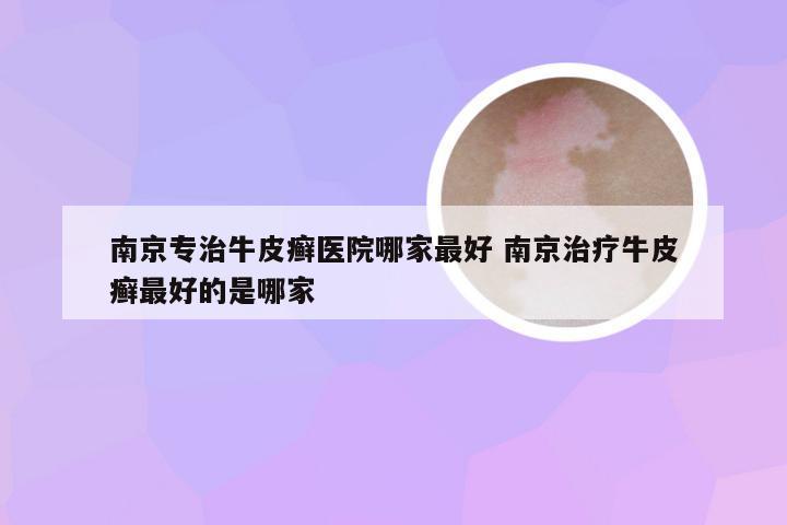 南京专治牛皮癣医院哪家最好 南京治疗牛皮癣最好的是哪家