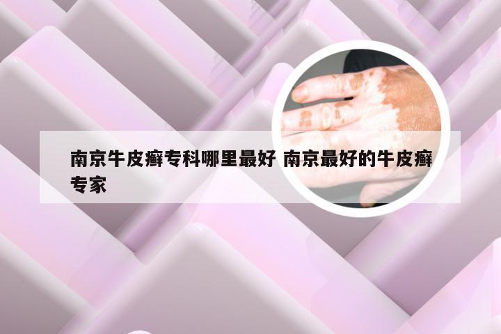 南京牛皮癣专科哪里最好 南京最好的牛皮癣专家
