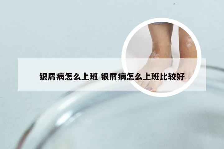 银屑病怎么上班 银屑病怎么上班比较好