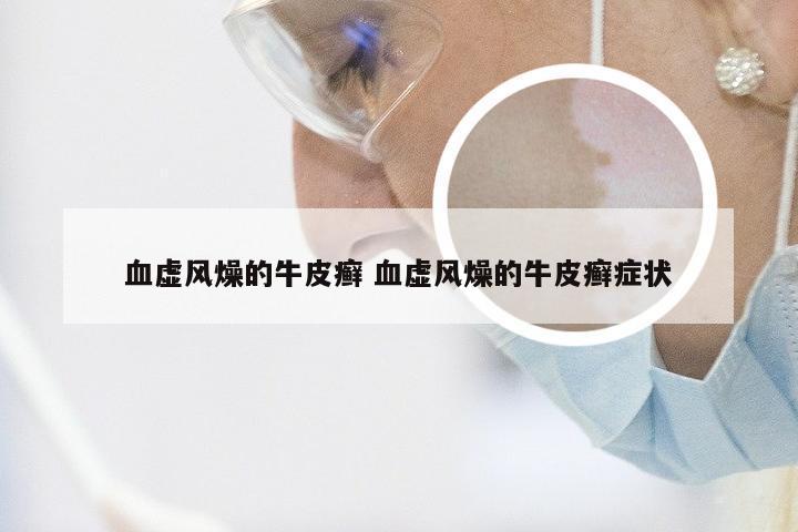血虚风燥的牛皮癣 血虚风燥的牛皮癣症状