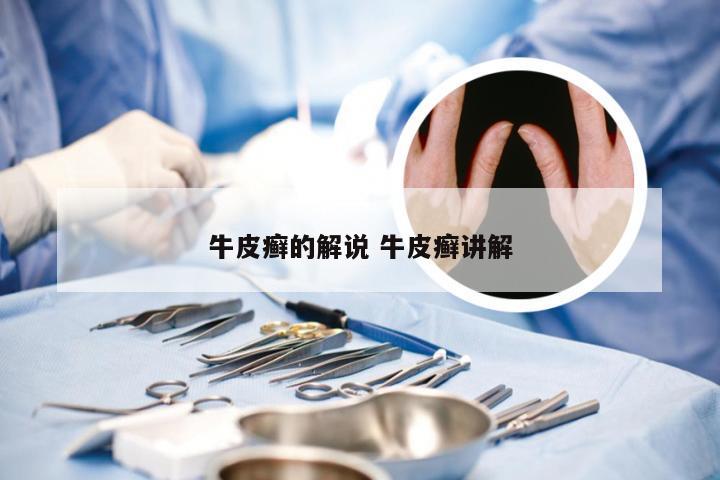 牛皮癣的解说 牛皮癣讲解