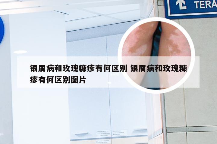 银屑病和玫瑰糠疹有何区别 银屑病和玫瑰糠疹有何区别图片