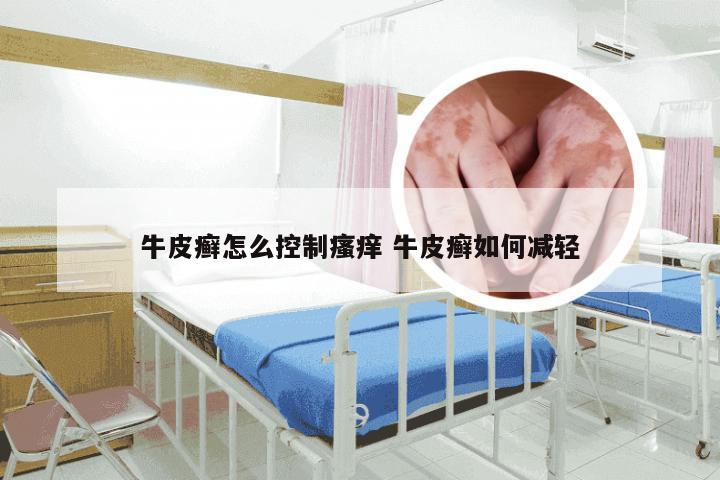 牛皮癣怎么控制瘙痒 牛皮癣如何减轻