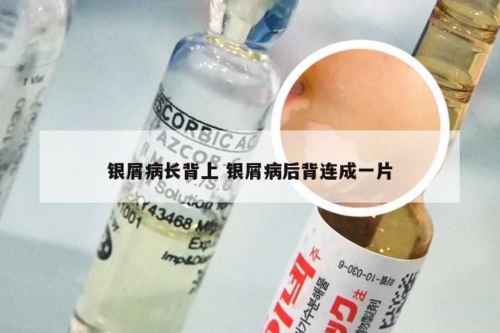 银屑病长背上 银屑病后背连成一片