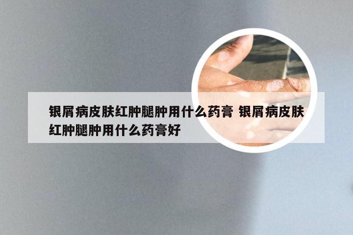 银屑病皮肤红肿腿肿用什么药膏 银屑病皮肤红肿腿肿用什么药膏好