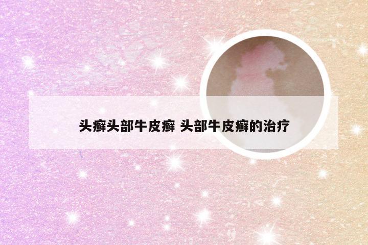 头癣头部牛皮癣 头部牛皮癣的治疗
