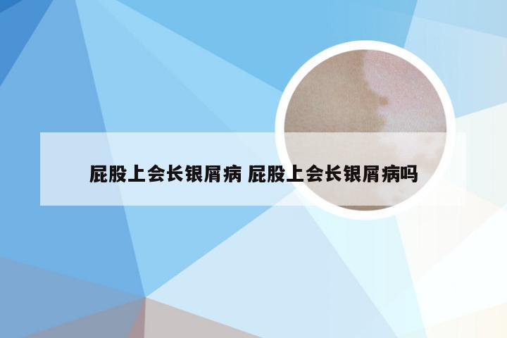 屁股上会长银屑病 屁股上会长银屑病吗