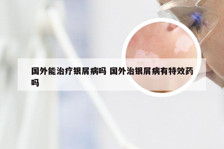 国外能治疗银屑病吗 国外治银屑病有特效药吗