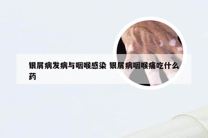 银屑病发病与咽喉感染 银屑病咽喉痛吃什么药