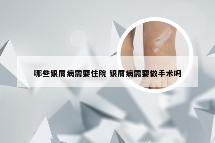 哪些银屑病需要住院 银屑病需要做手术吗