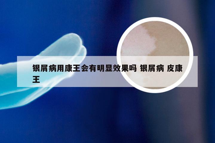 银屑病用康王会有明显效果吗 银屑病 皮康王